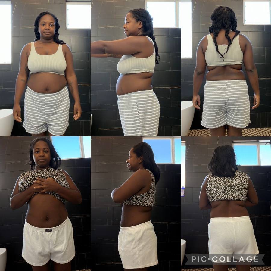 frances before and after, front, side, and back views